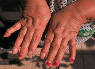 Millones de latinos padecen de artritis y de escasa información en español