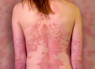 Psoriasis ¡Menos tabú más comprensión!