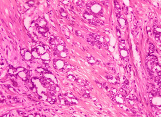 Médicos piden renombrar el cáncer de próstata de bajo grado