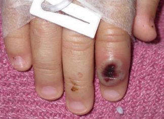 Detectado en Florida un posible caso de viruela del mono