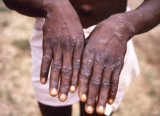 Aumentan 77% casos de viruela símica en una semana, dice OMS