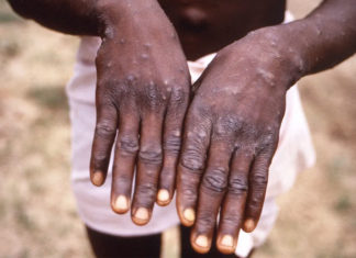 Viruela símica podría ser declarada una emergencia mundial