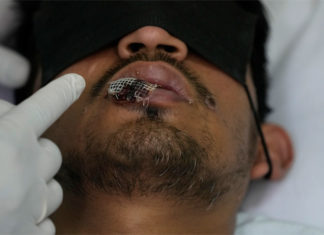 OPS: Américas epicentro de brote de viruela símica