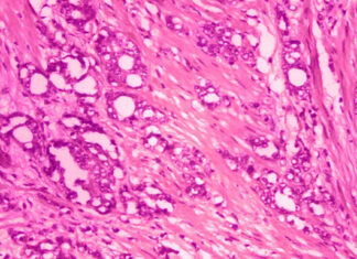 Estudio: Tratamiento para cáncer de próstata puede esperar