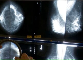¿Se puede confiar en una mamografía para identificar el riesgo de enfermedad cardíaca? mamografía