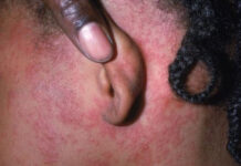 Alerta de Salud por posible exposición a sarampión en el Aeropuerto Internacional de Filadelfia Measles