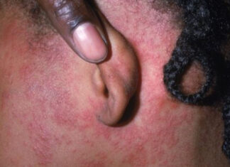 Health Department Issues Notification About Potential Measles Exposure Measles