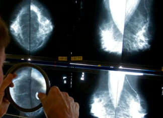 Mammograms should start at 40 to address rising breast cancer rates at younger ages, panel says cancer