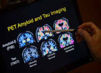 Blood tests for Alzheimer’s may be coming to your doctor’s office. Here’s what to know Alzheimer's