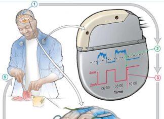 Un marcapasos cerebral personalizado reduce los síntomas en pacientes con parkinson cerebral