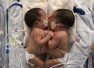 Siameses celebran su primer cumpleaños luego de exitosa cirugía de separación Siameses