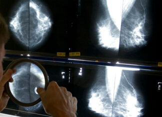 Algunas pacientes de cáncer de mama podrían evitar ciertas cirugías, sugieren estudios