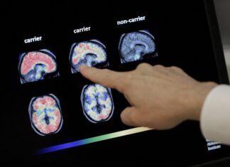 Vivir más tiempo podría aumentar el riesgo de demencia, pero hay formas de reducirlo demencia