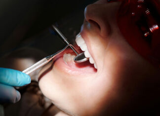 ¿Cuál es la relación entre la salud dental y el Alzheimer? Alzheimer