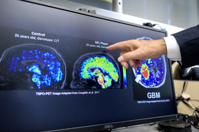 Científicos latinos en EEUU hallan biomarcador que podría detectar temprano el Alzheimer