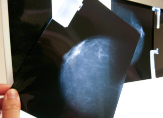 Expertos alertan sobre la falta de registros de cáncer de mama en América Latina cáncer