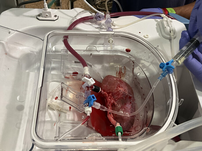 Logran primer trasplante a cerdos de riñones porcinos modificados con organoides humanos