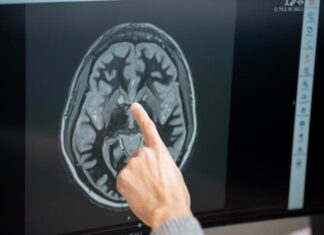 Logran medir la actividad cerebral de una paciente tratada con un fármaco antiobesidad fármaco