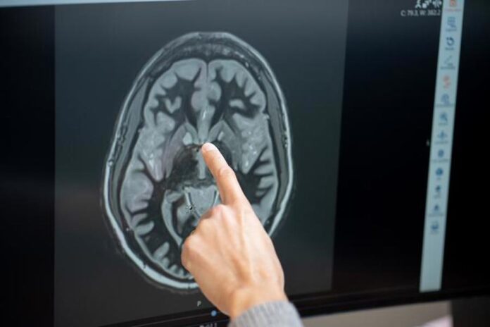 Logran medir la actividad cerebral de una paciente tratada con un fármaco antiobesidad fármaco