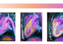 Los hipertensos son más susceptibles a los daños que causa un fármaco contra el cáncer