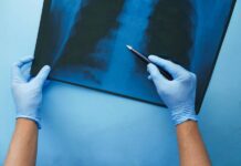 Salud emite orden administrativa ante la escasez de pruebas de detección de tuberculosis