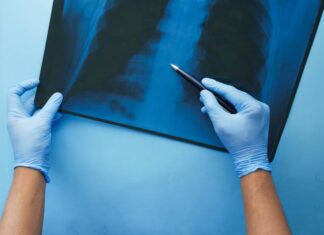 Salud emite orden administrativa ante la escasez de pruebas de detección de tuberculosis
