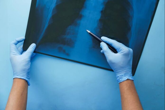 Salud emite orden administrativa ante la escasez de pruebas de detección de tuberculosis